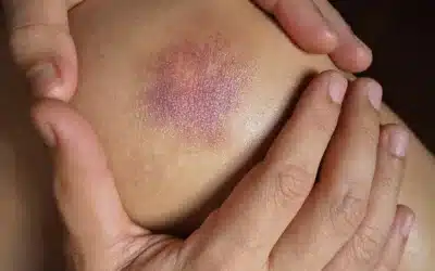 Yog ib tug bruise?